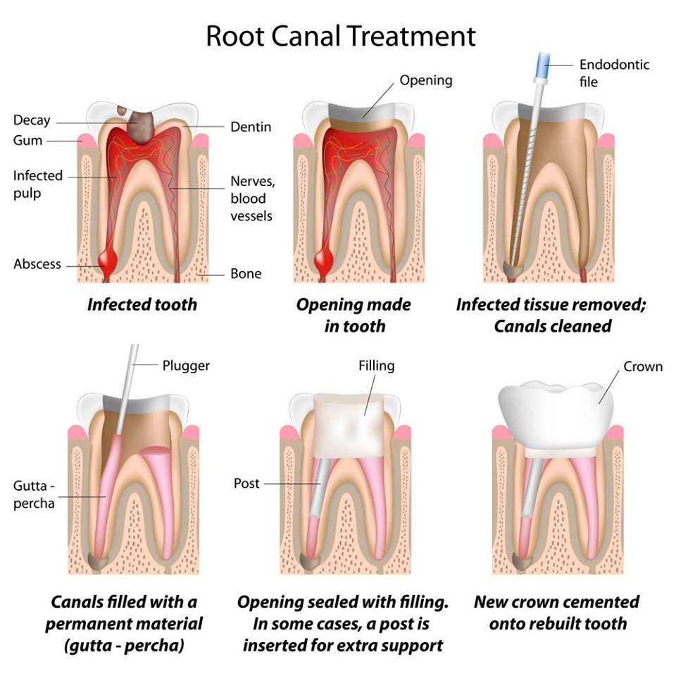 Root Canal Treatment Rct Multispecialty Dental Clinic 6781